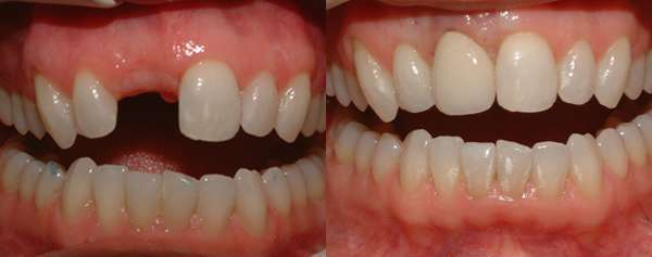 Implante Dente da Frente